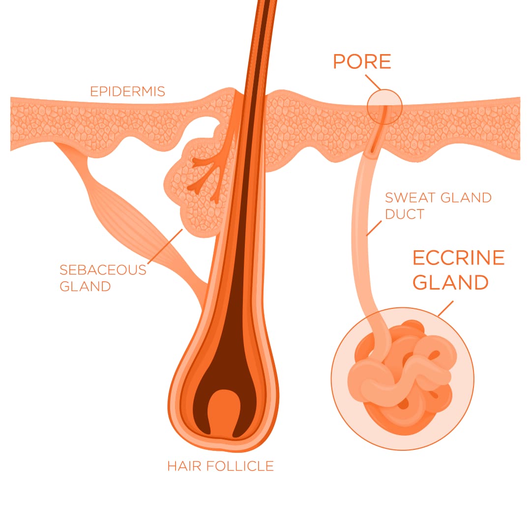 Skin diagram illustrating the eccrine gland leading to inflammation in the skin pore.